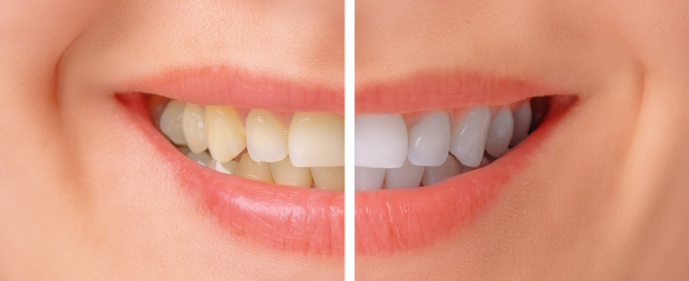 दांतों को सफ़ेद करने के प्राकृतिक उपाय