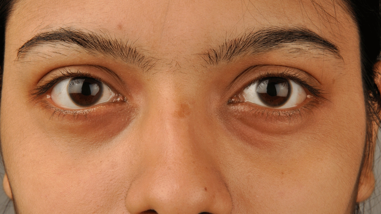 आंखों के नीचे गड्ढे और धंसी हुई आँखों के कारण और इलाज - दा इंडियन वायर