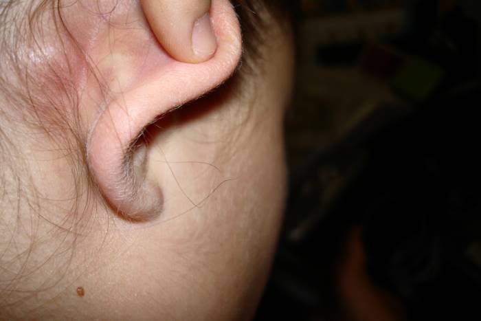 कान के पीछे गांठ