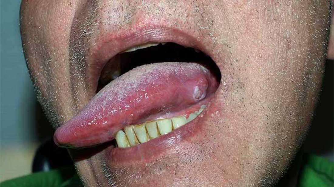 tongue cancer