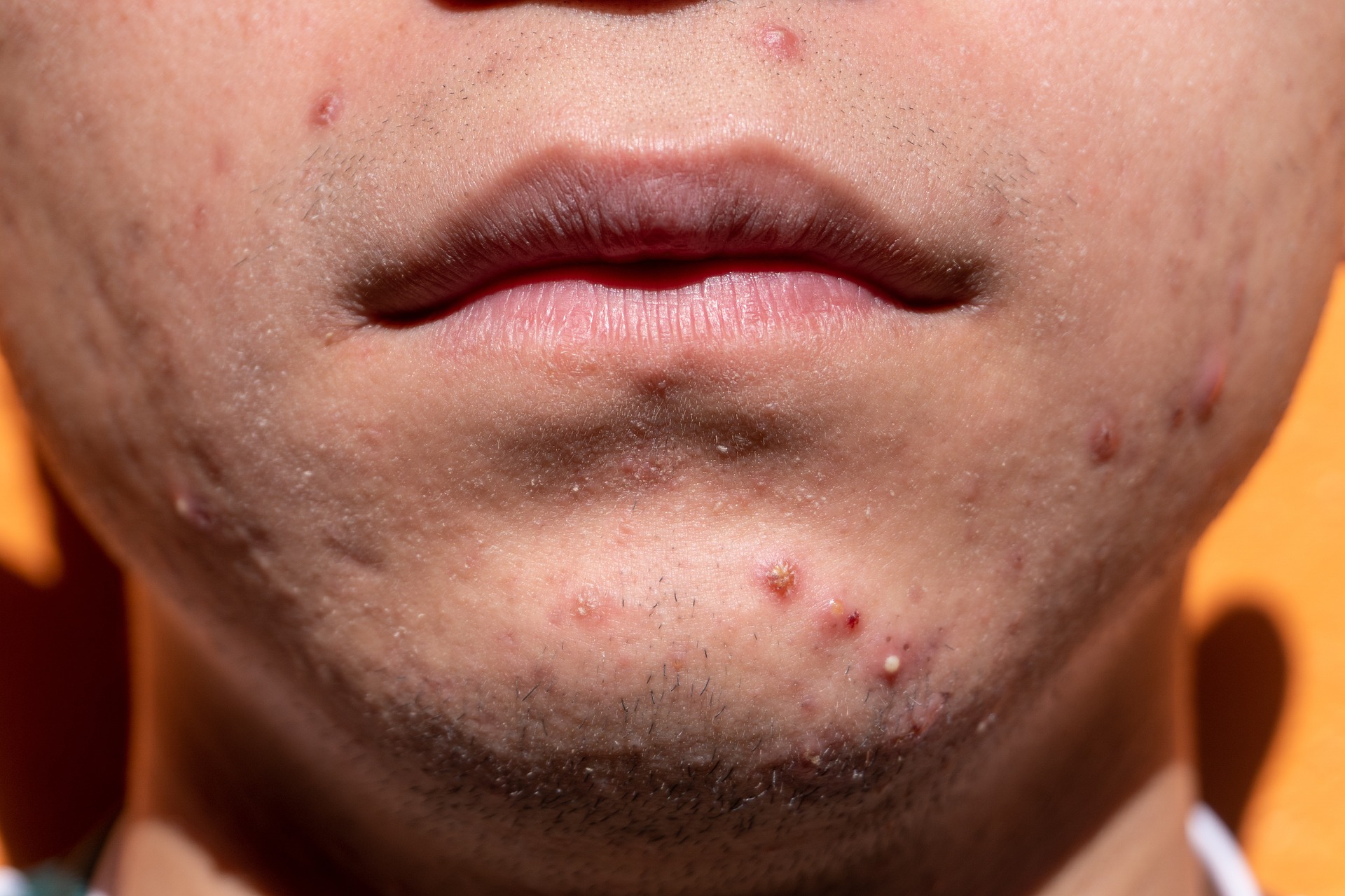 Home Remedy: मुंहासे ( Pimples) ठीक करने के 5 असरदार घरेलू नुस्खे